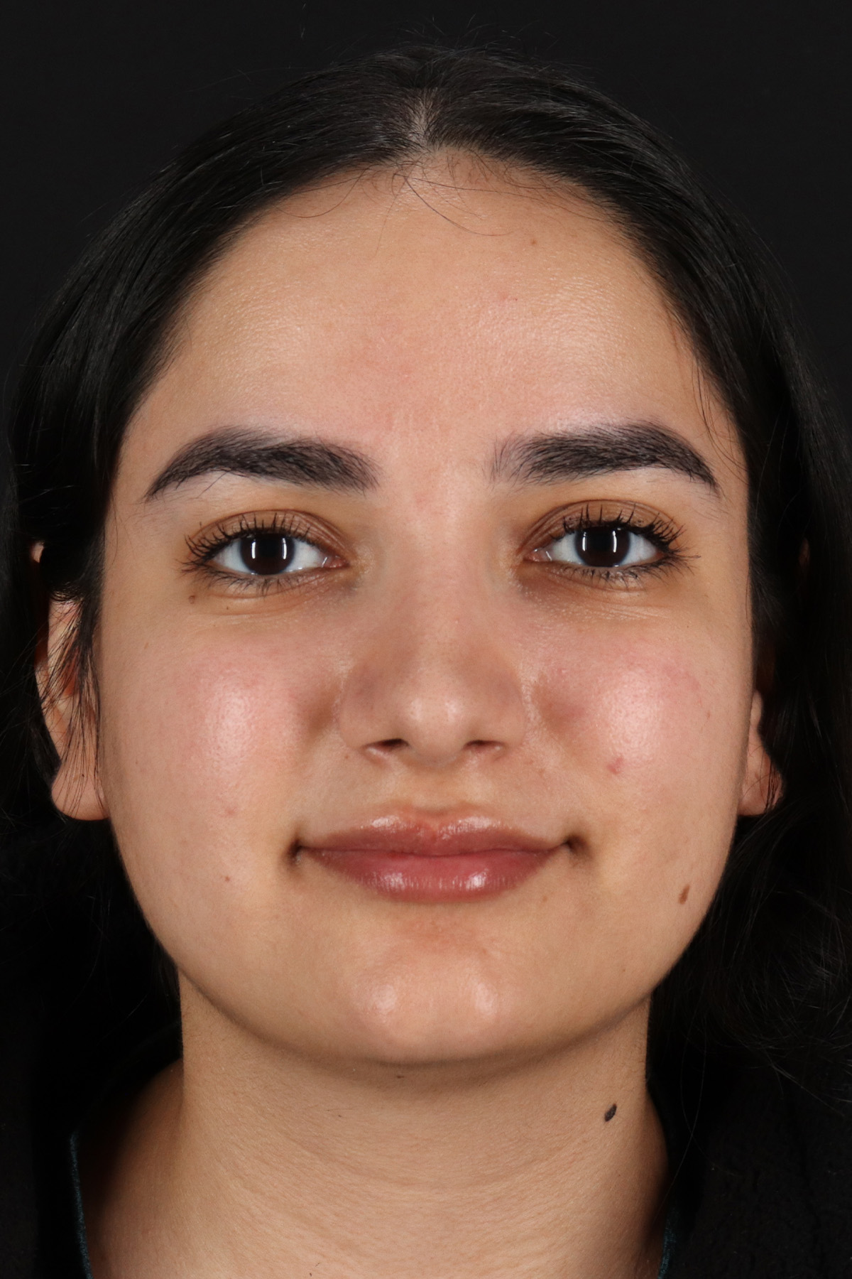 Rhinoplasty Before & After Patient #3071