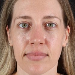 Rhinoplasty Before & After Patient #3291
