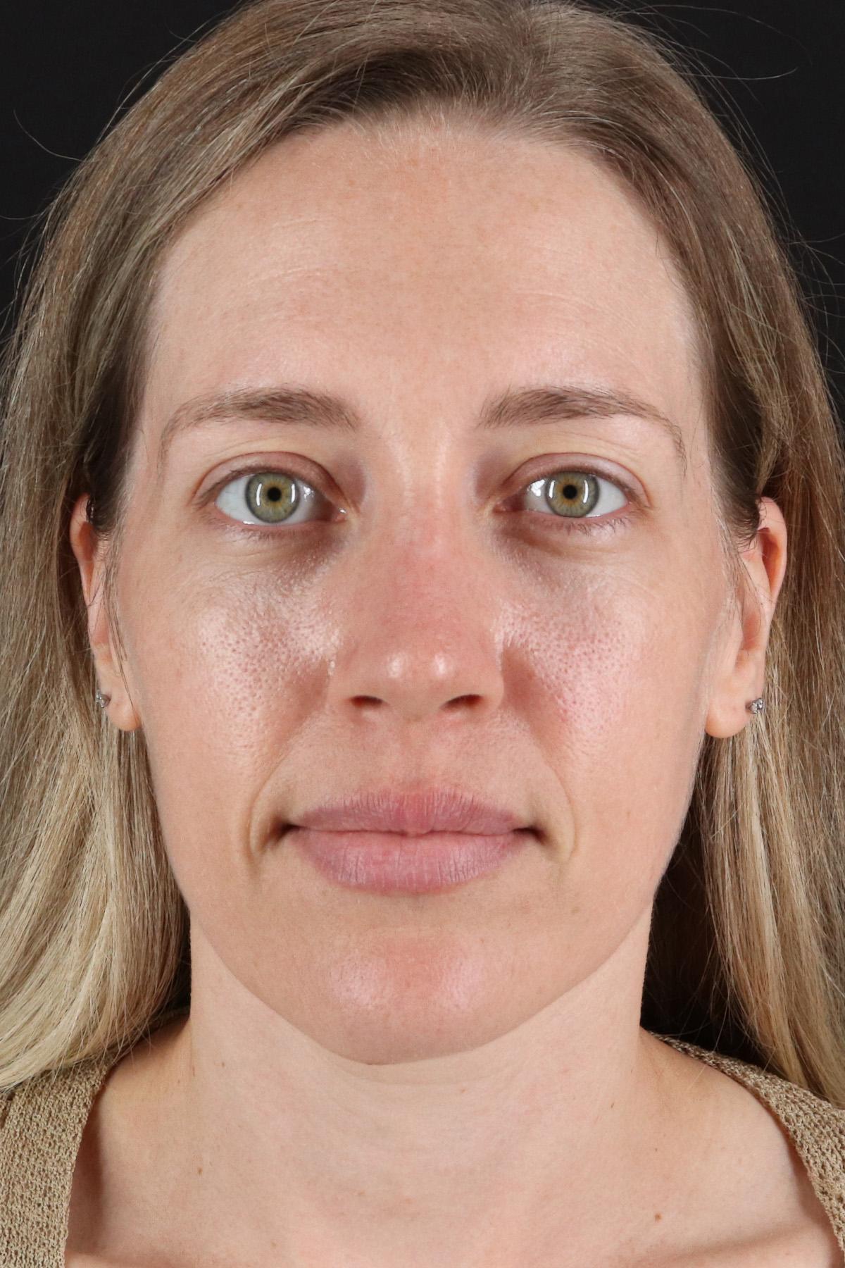 Rhinoplasty Before & After Patient #3291