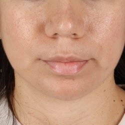 Chin Implant Before & After Patient #1540