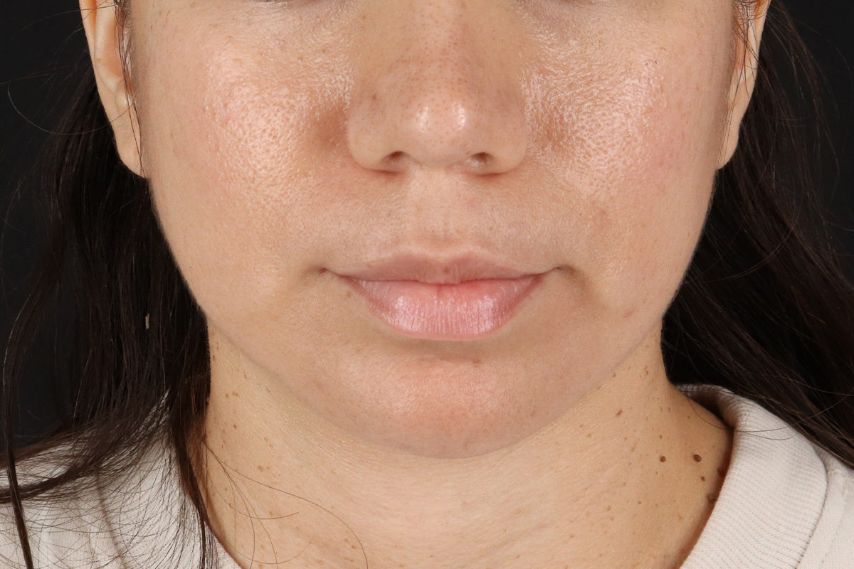 Chin Implant Before & After Patient #1540