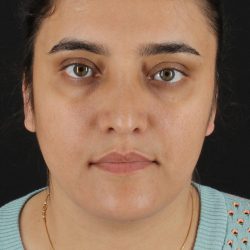 Neck Lift Before & After Patient #2560