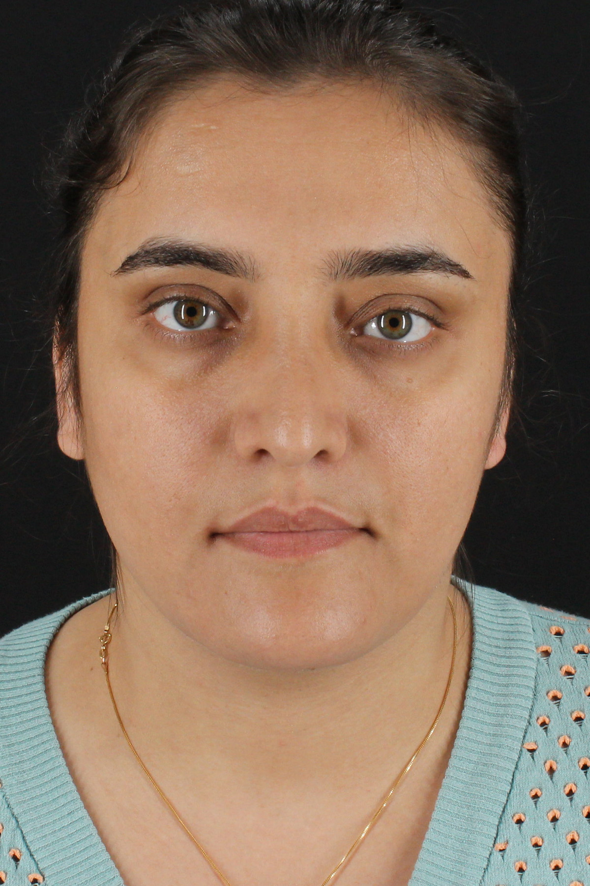 Neck Lift Before & After Patient #2560