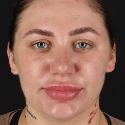 Rhinoplasty Before & After Patient #3104