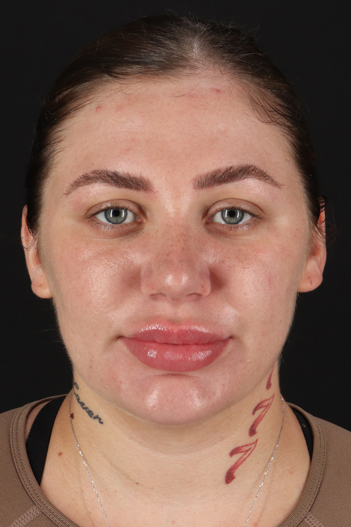 Rhinoplasty Before & After Patient #3104