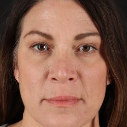Lip Lift Before & After Patient #2133