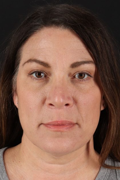 Lip Lift Before & After Patient #2133