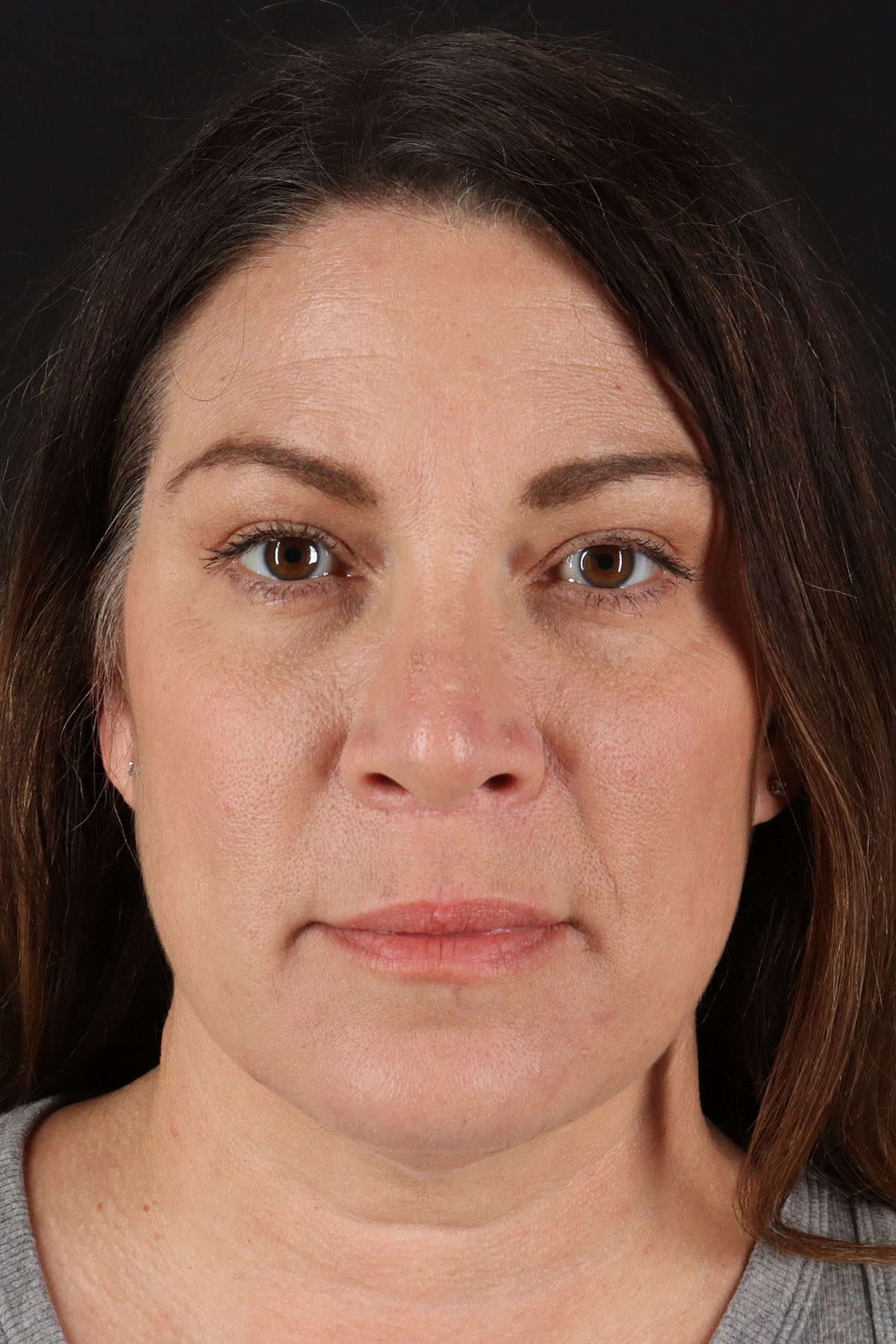 Lip Lift Before & After Patient #2133