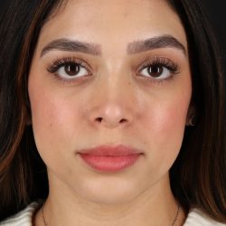 Rhinoplasty Before & After Patient #3269