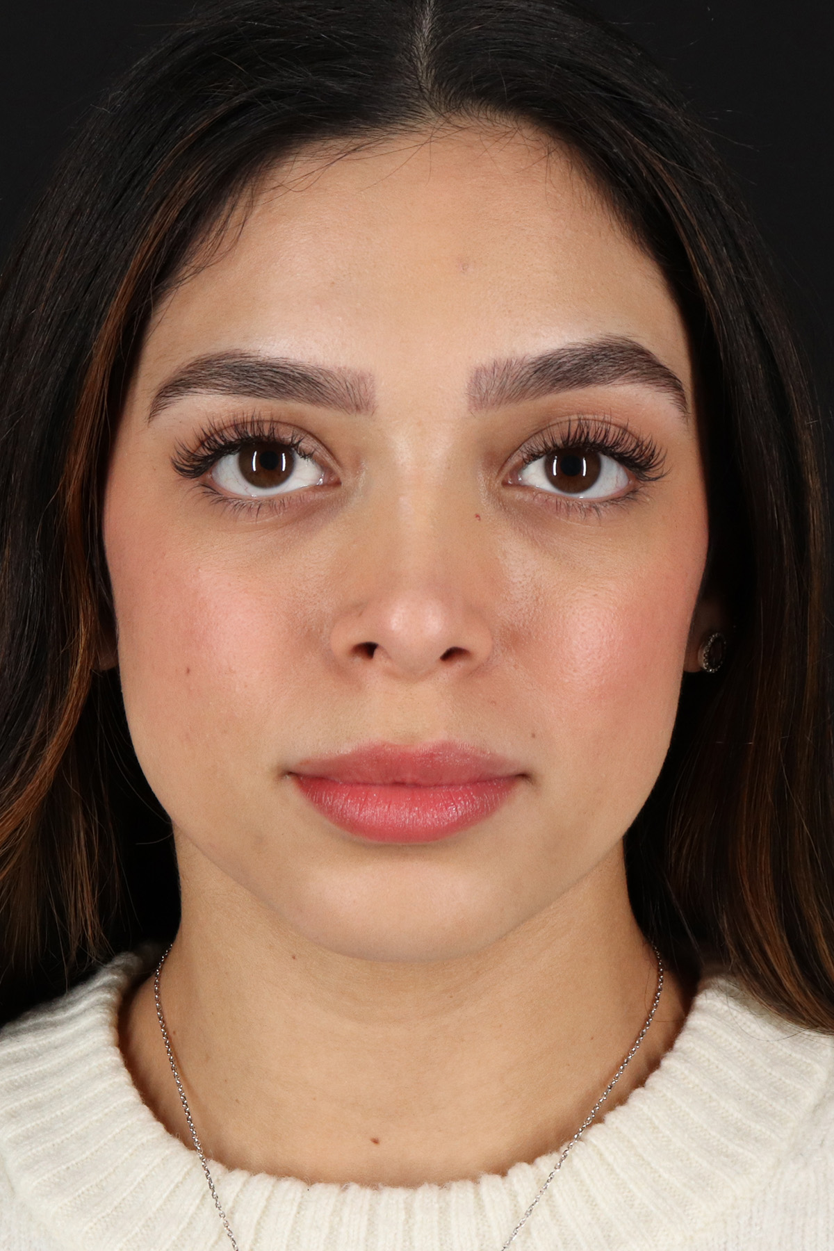 Rhinoplasty Before & After Patient #3269
