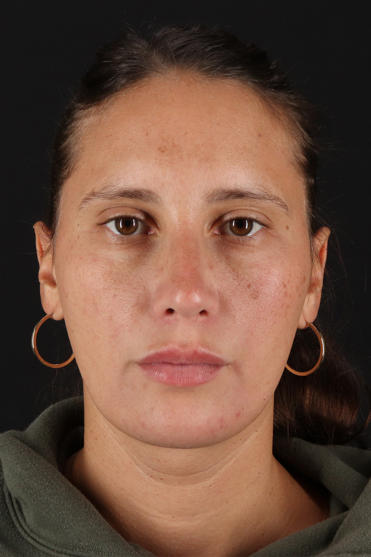 Neck Liposuction Before & After Patient #2719