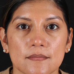 Rhinoplasty Before & After Patient #3181