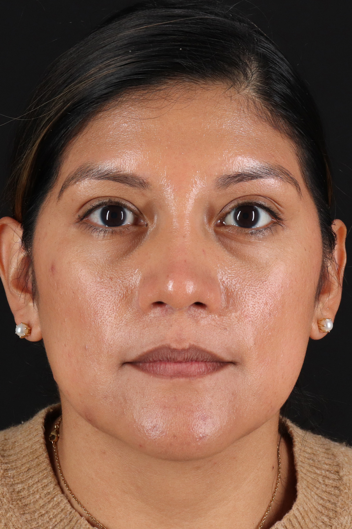 Rhinoplasty Before & After Patient #3181
