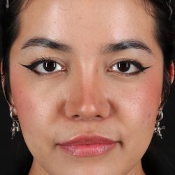 Liquid Rhinoplasty Before & After Patient #2265