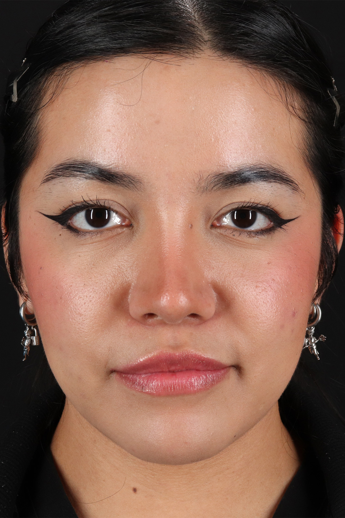 Liquid Rhinoplasty Before & After Patient #2265