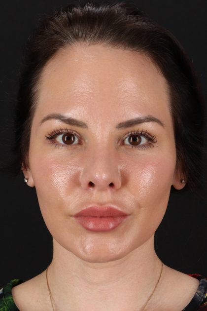 Buccal Fat Pad Before & After Patient #1425