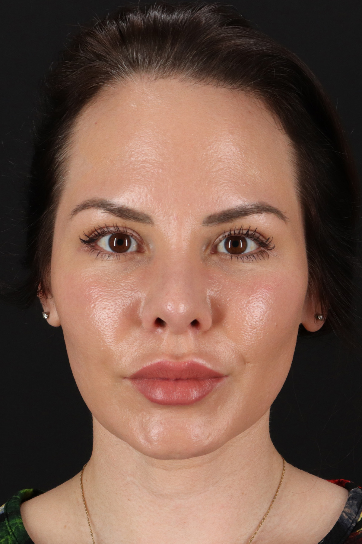 Buccal Fat Pad Before & After Patient #1425