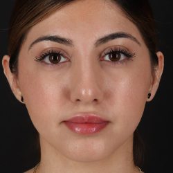 Rhinoplasty Before & After Patient #3214