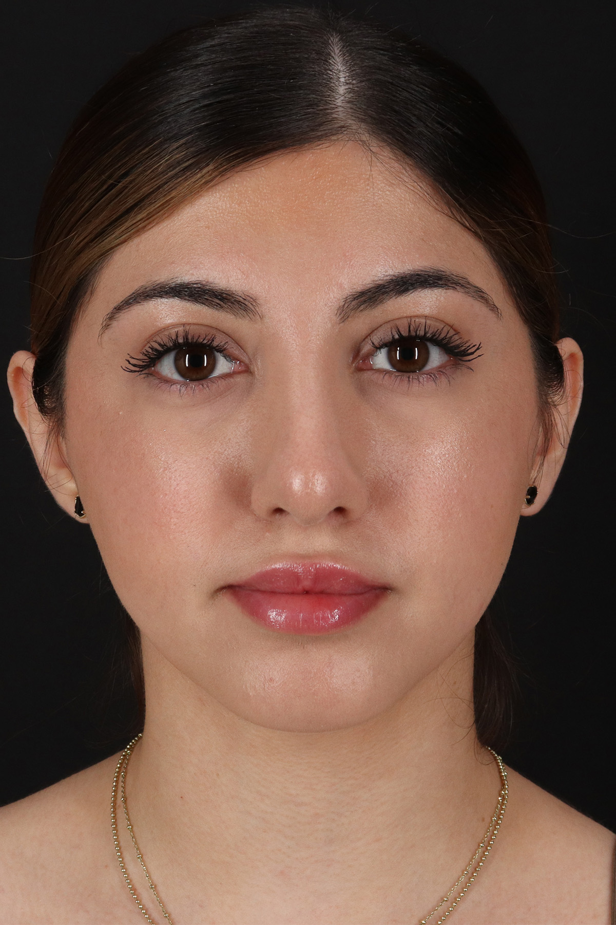 Rhinoplasty Before & After Patient #3214