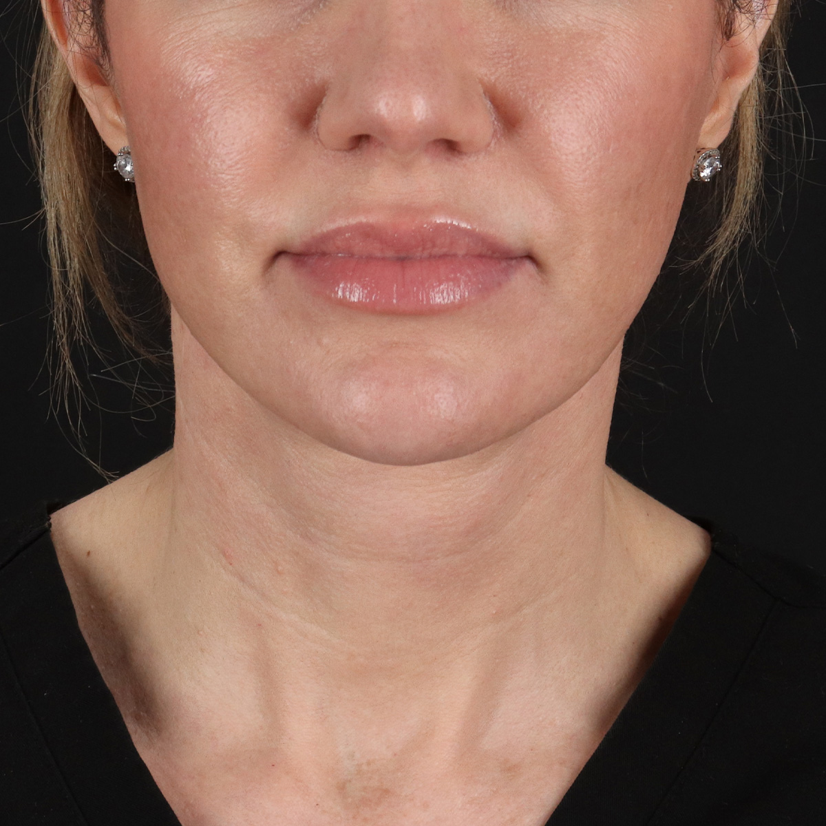 Facelift Before & After Patient #1921