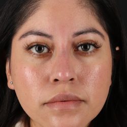 Liquid Rhinoplasty Before & After Patient #2290