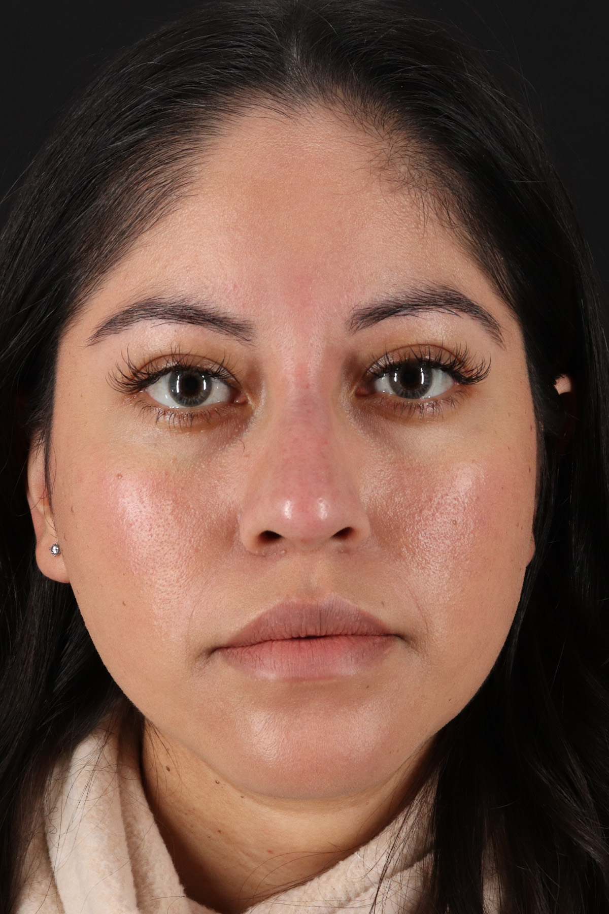 Liquid Rhinoplasty Before & After Patient #2290
