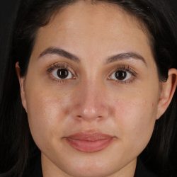 Rhinoplasty Before & After Patient #3236