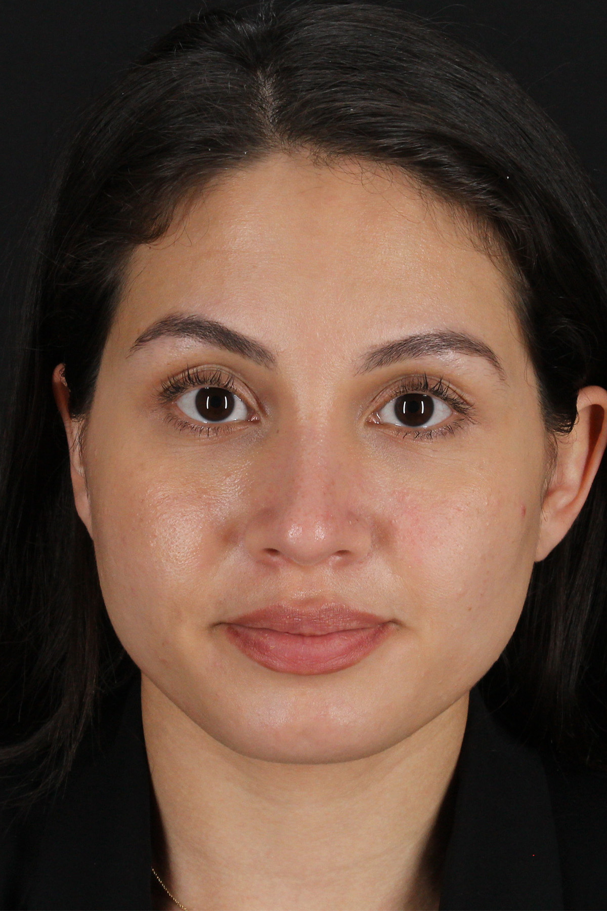 Rhinoplasty Before & After Patient #3236