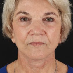 Facelift Before & After Patient #1943