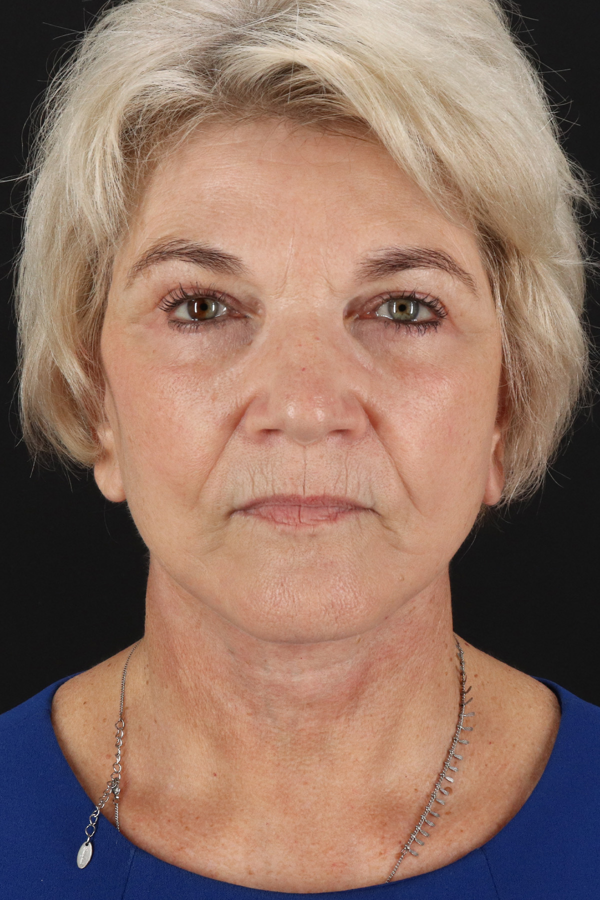 Neck Lift Before & After Patient #2648