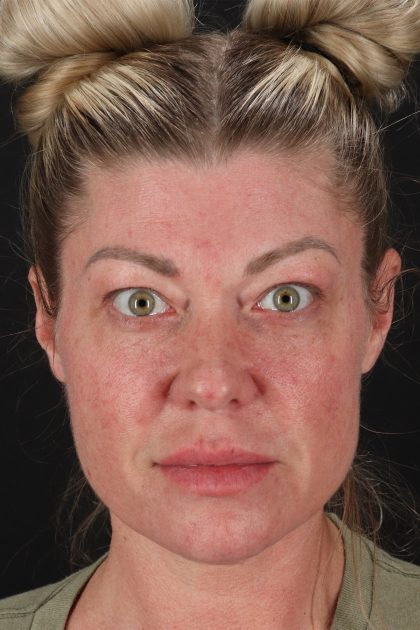Fat Grafting To The Face Before & After Patient #2016