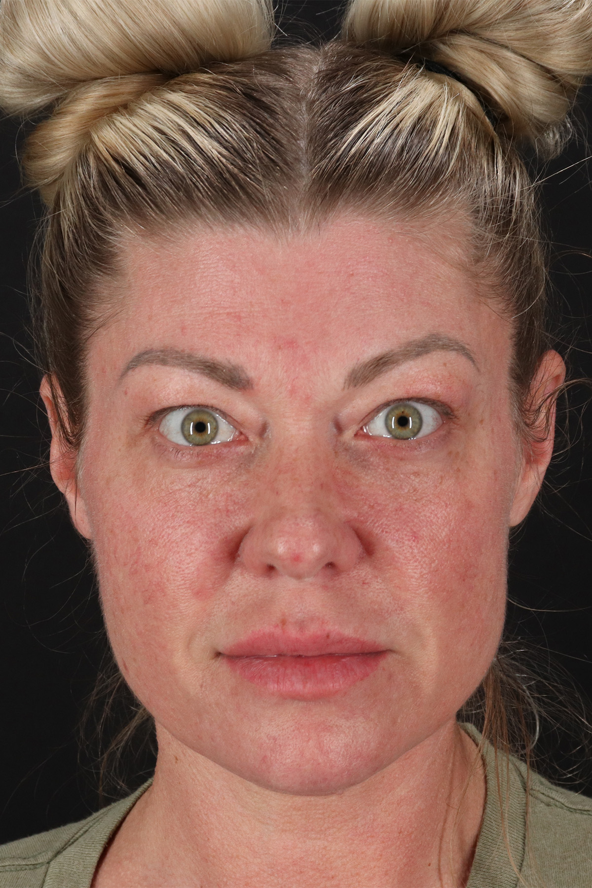 Fat Grafting To The Face Before & After Patient #2016