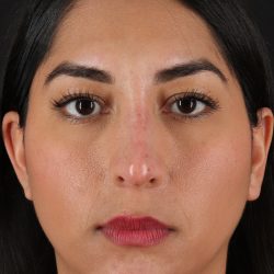 Liquid Rhinoplasty Before & After Patient #2232