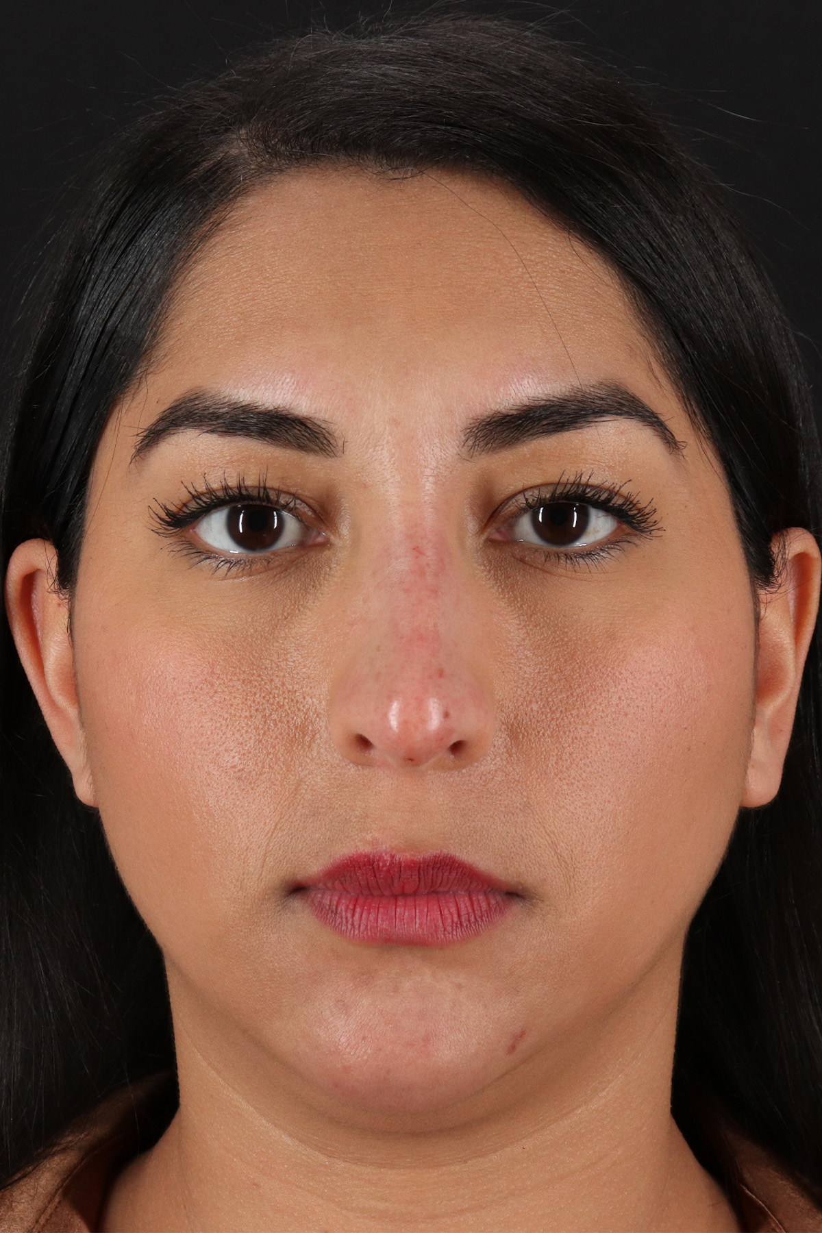 Liquid Rhinoplasty Before & After Patient #2232