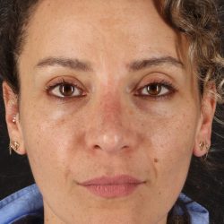 Liquid Rhinoplasty Before & After Patient #2276