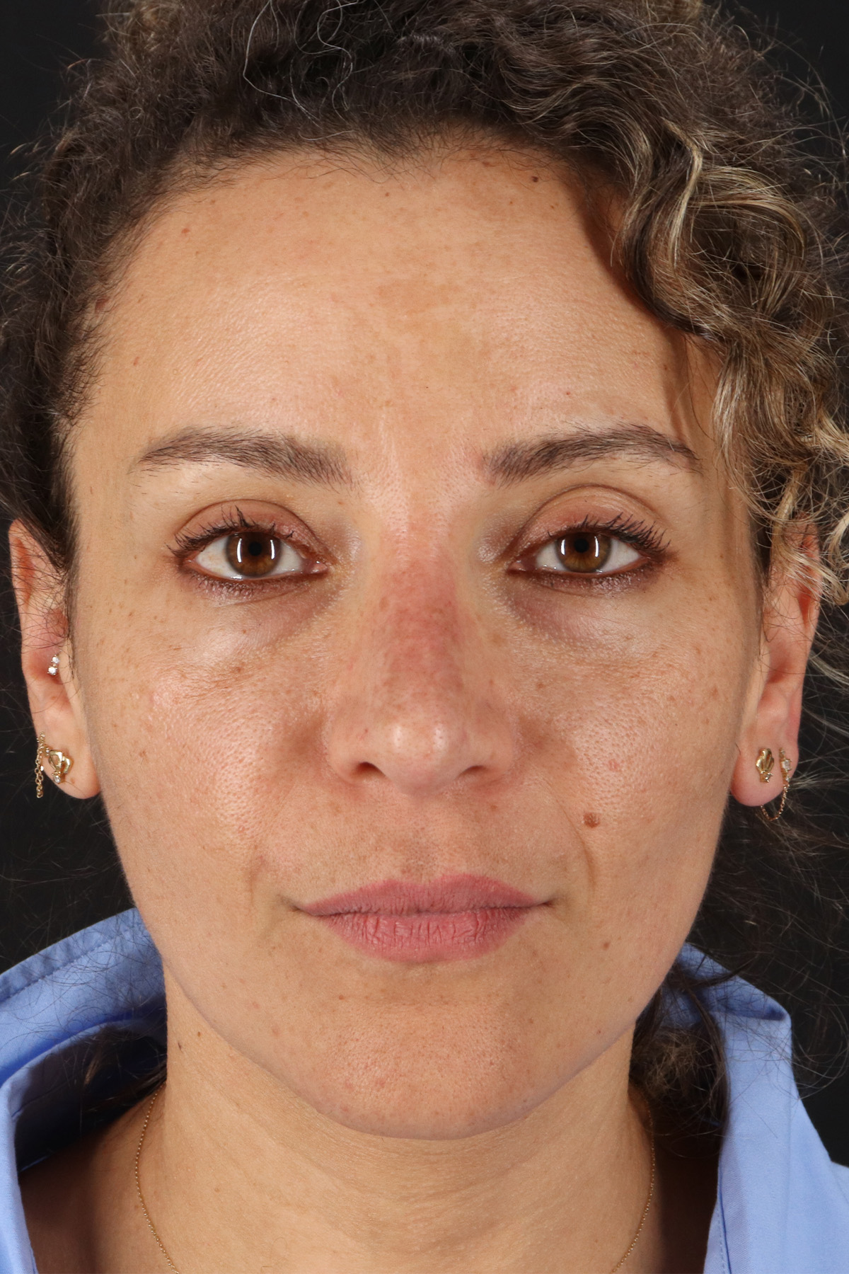 Liquid Rhinoplasty Before & After Patient #2276