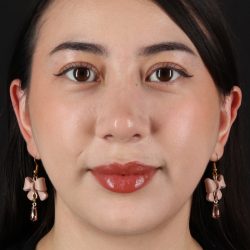 Rhinoplasty Before & After Patient #3159
