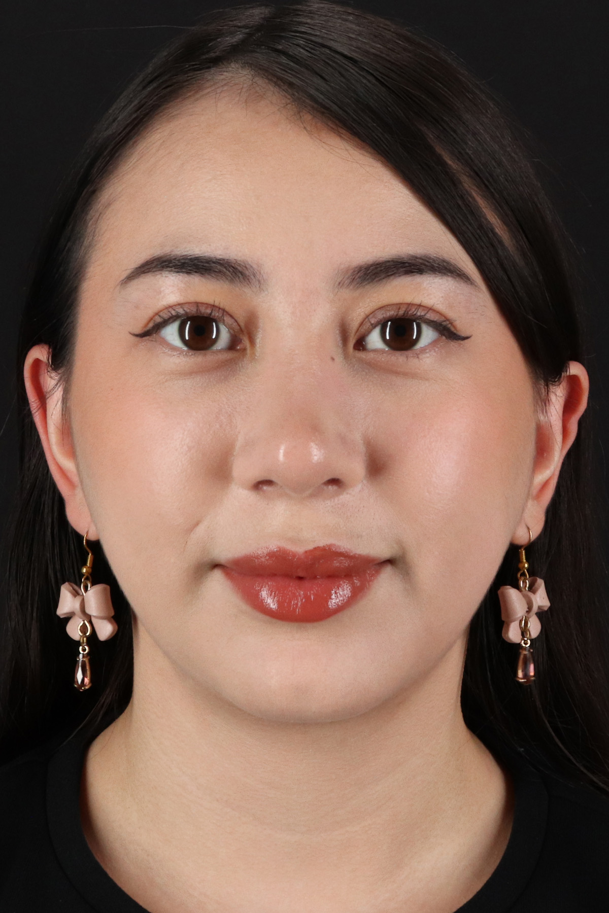 Rhinoplasty Before & After Patient #3159