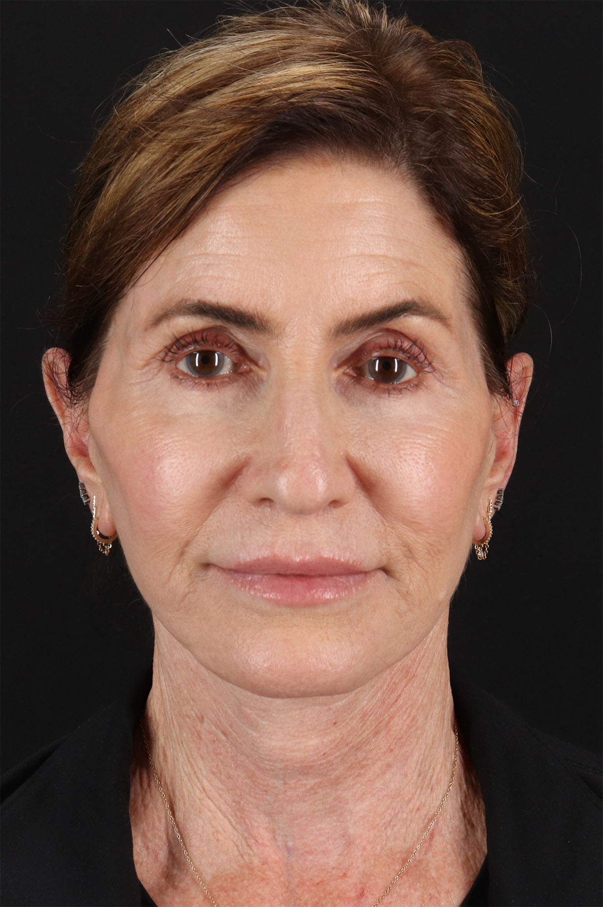 Co2 Laser Before & After Patient #3346