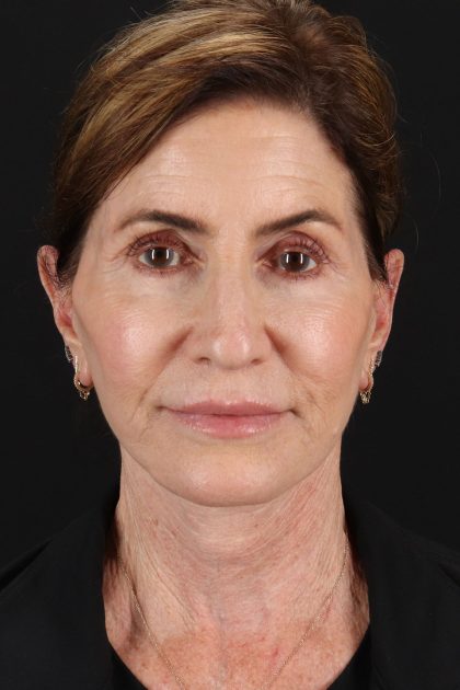 Lip Lift Before & After Patient #2122