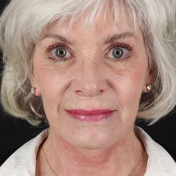 Upper Blepharoplasty Before & After Patient #5377