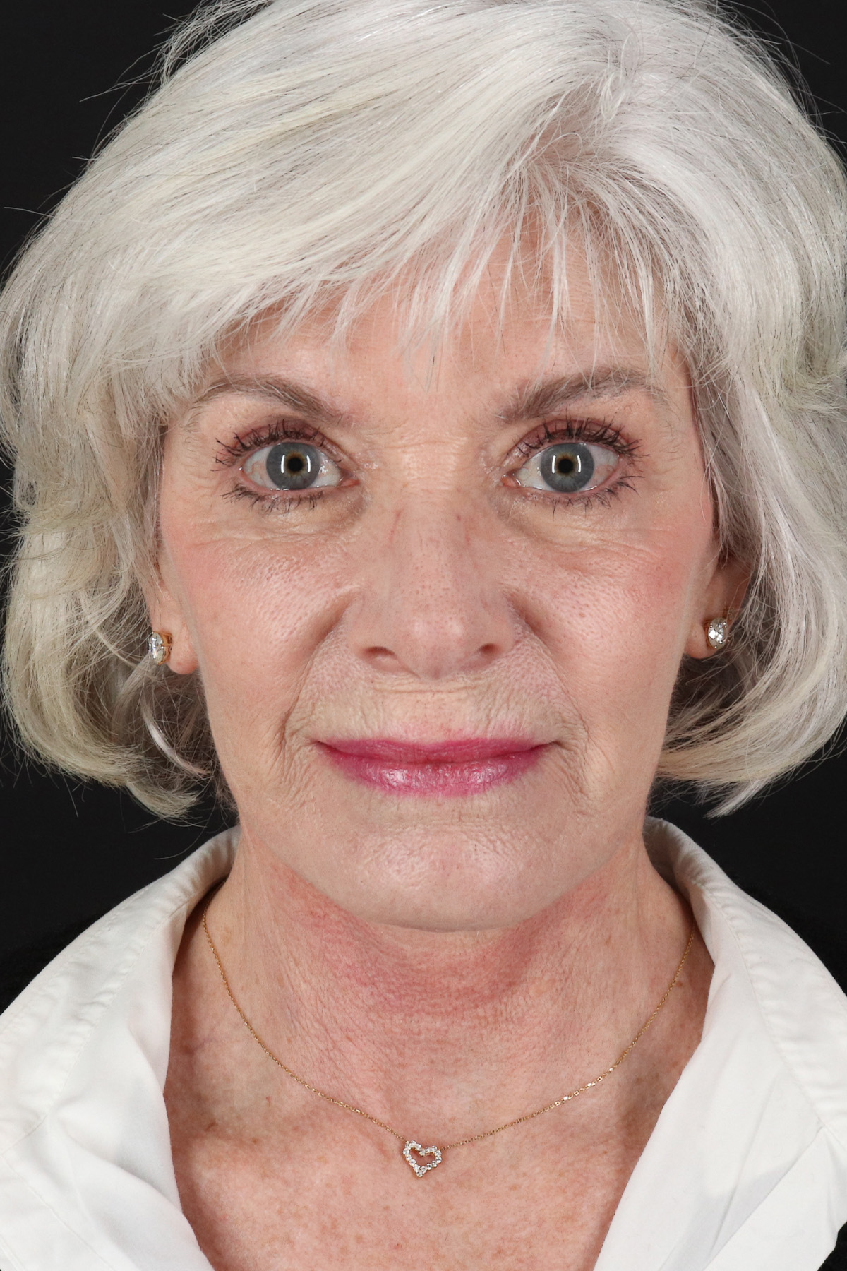 Upper Blepharoplasty Before & After Patient #5377