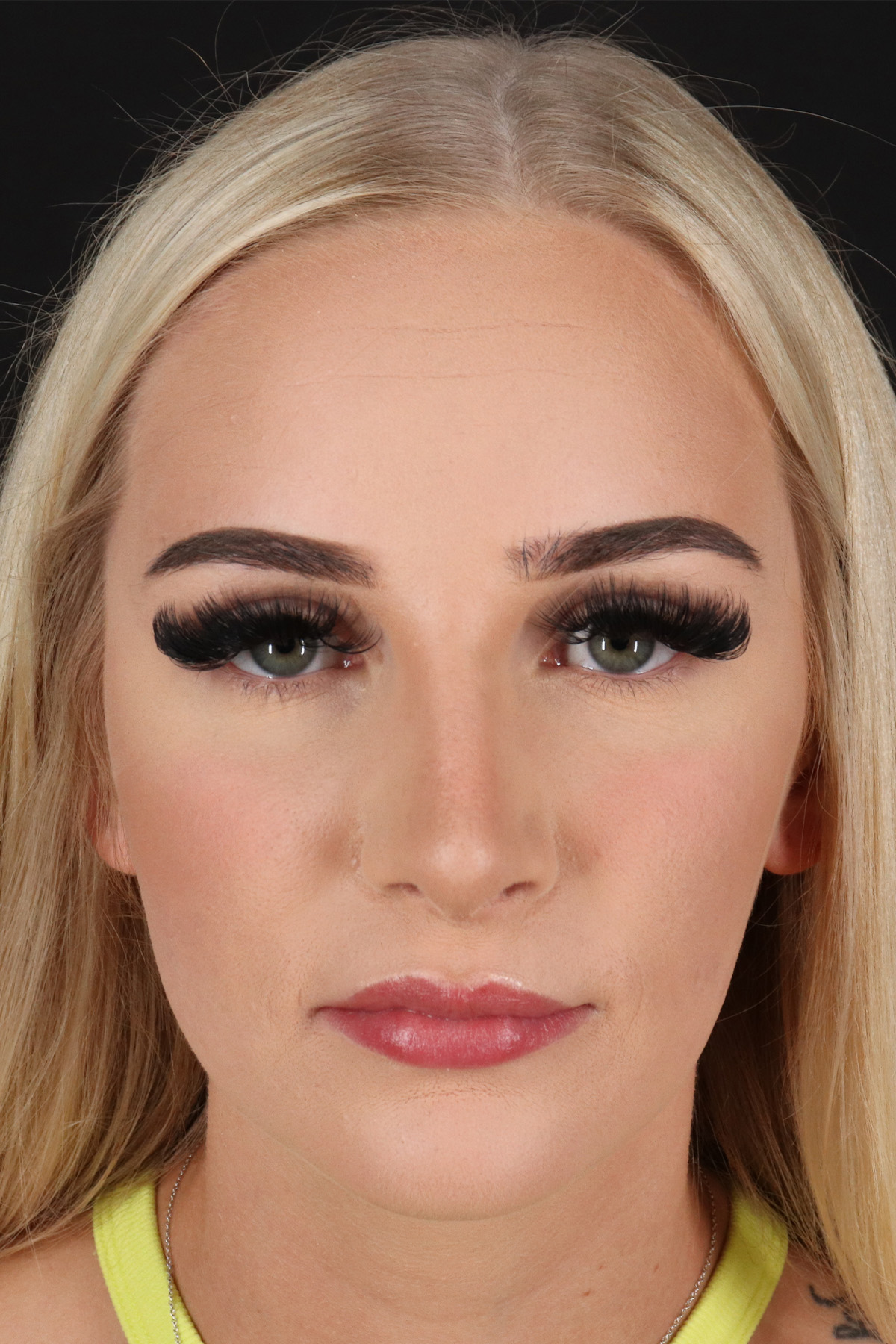 Rhinoplasty Before & After Patient #2807