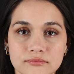 Rhinoplasty Before & After Patient #3258
