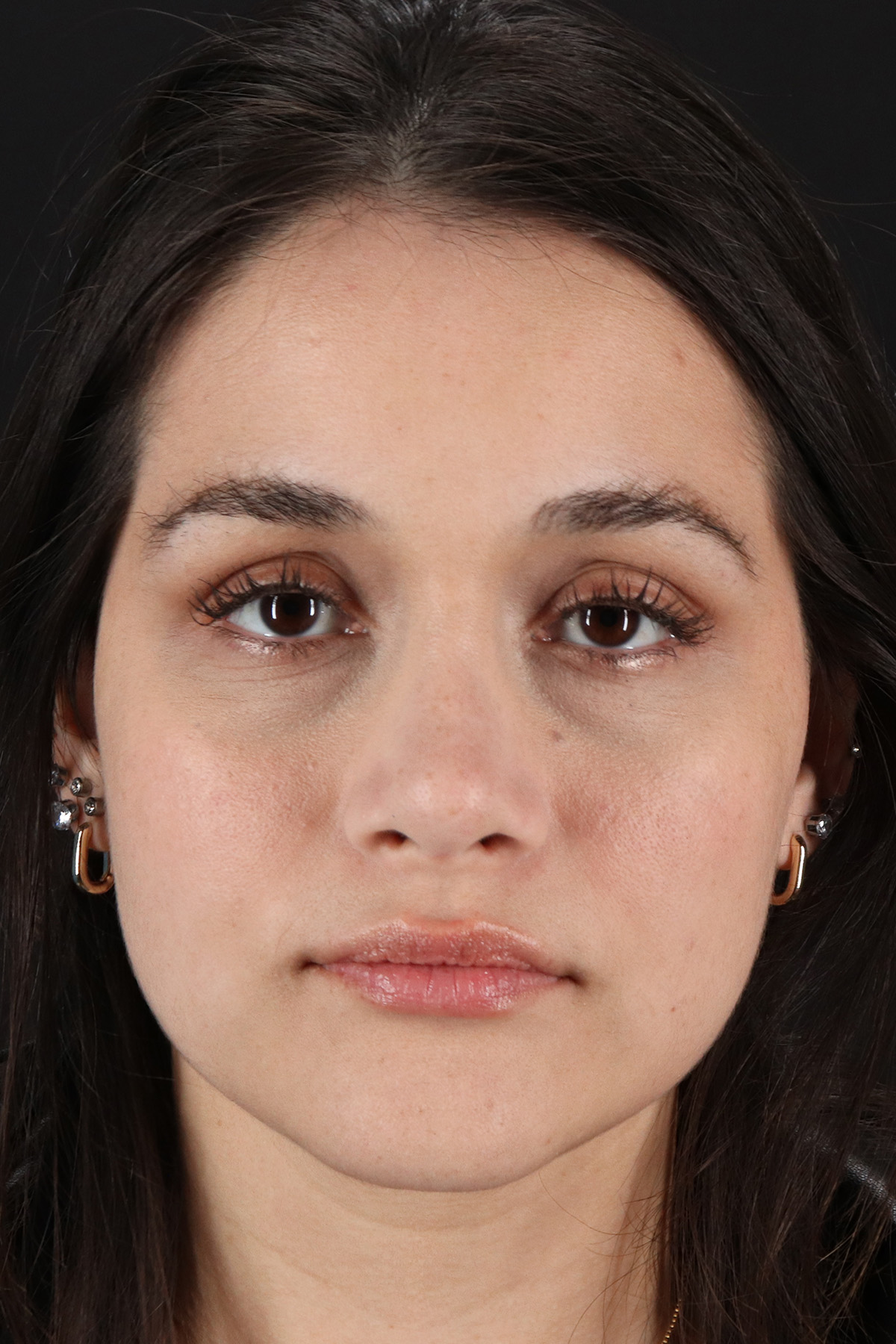 Rhinoplasty Before & After Patient #3258