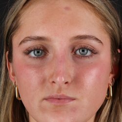 Liquid Rhinoplasty Before & After Patient #2221