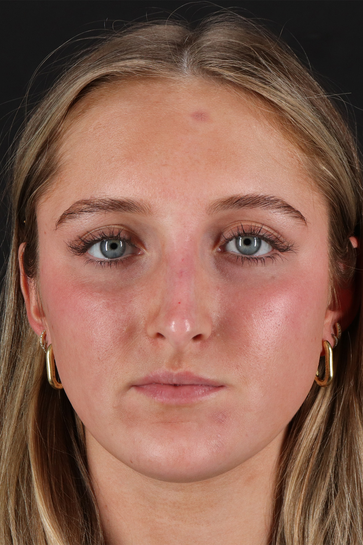 Liquid Rhinoplasty Before & After Patient #2221