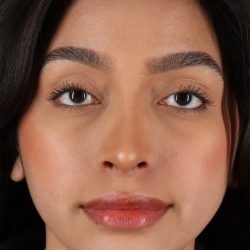 Chin Implant Before & After Patient #1637