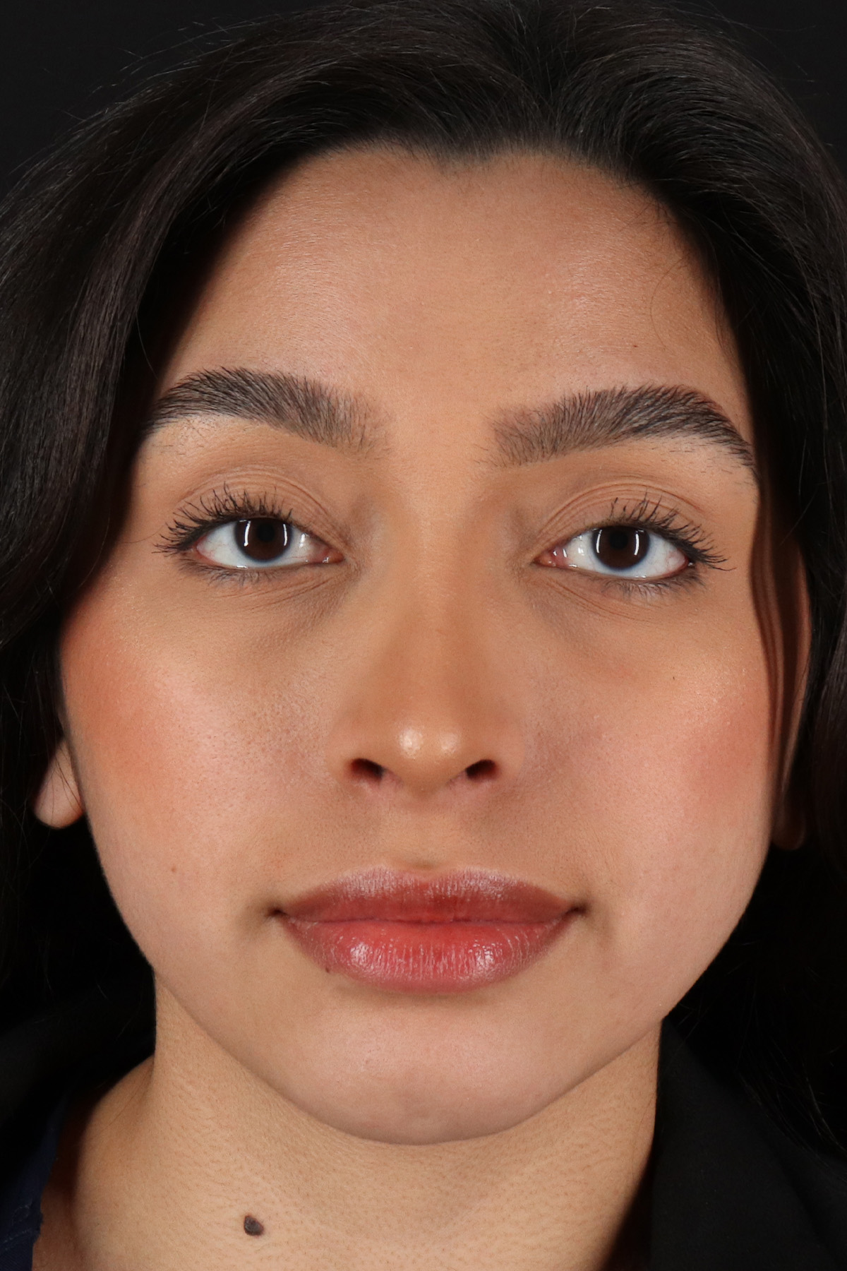 Chin Implant Before & After Patient #1637
