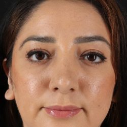 Rhinoplasty Before & After Patient #3115